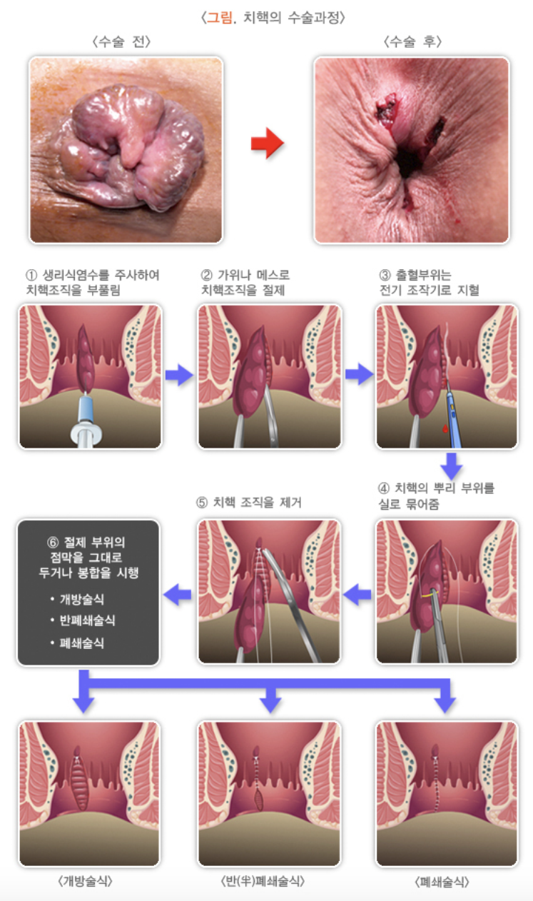 치핵의 수술과정