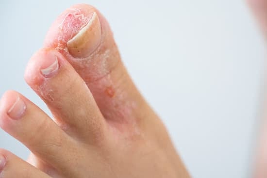 무좀 – 여름뿐만 아니라 1년 내내 주의해야 할 발 질환