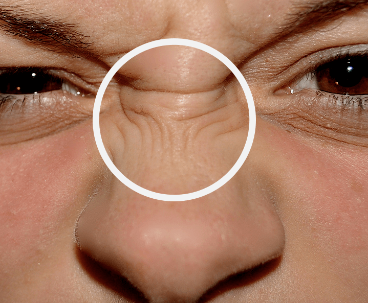 콧등 잔주름이 보이는 얼굴 클로즈업 이미지로 표정 주름 관리와 레티놀 성분 활용한 스킨케어 방법을 안내하는 피부 관리 콘텐츠재시도