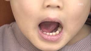 입냄새로 알 수 있는 병