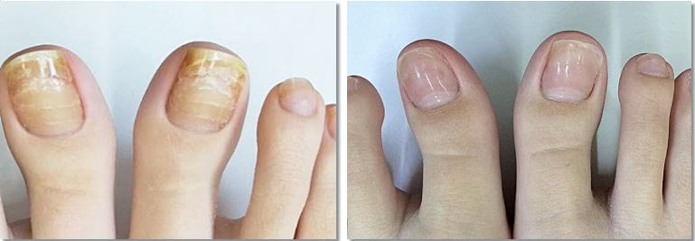 발톱 무좀 치료 후 호전 상태