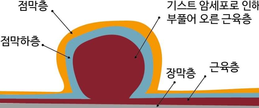 근육층에서 발생하는 기스트암