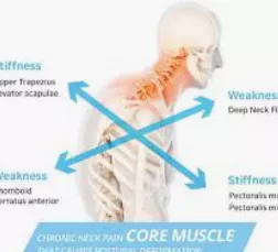 거북목-교정운동-거북목-증상-건강