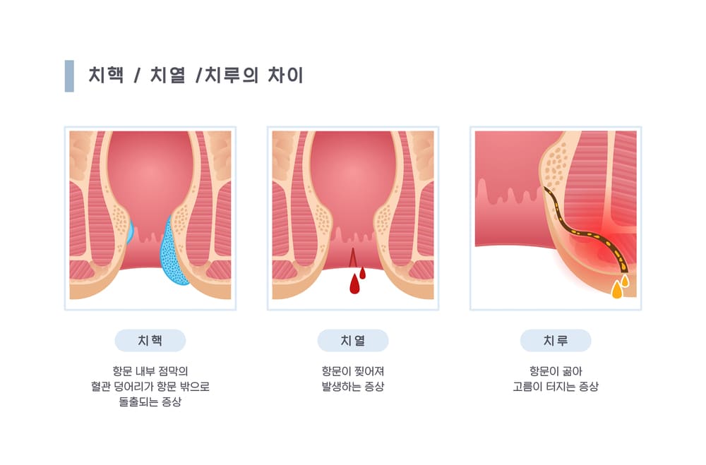 치질의 3종류 - 치핵, 치열, 치루
