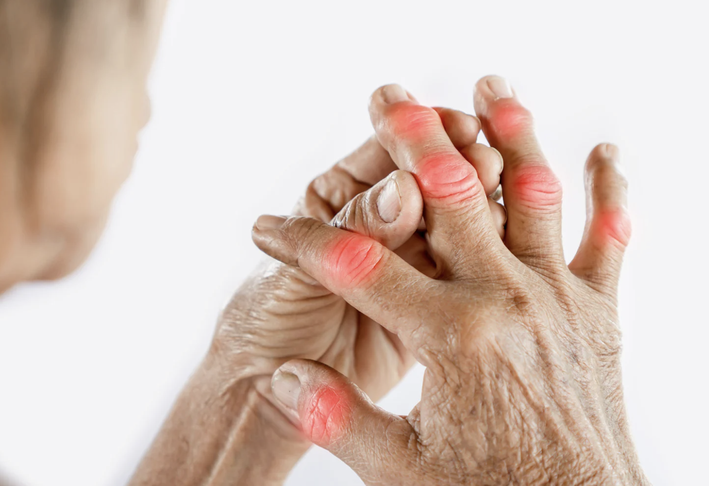 finger arthritis