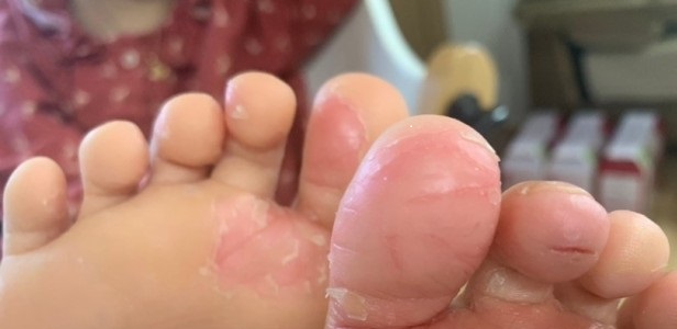 족선염이 나타난 발가락