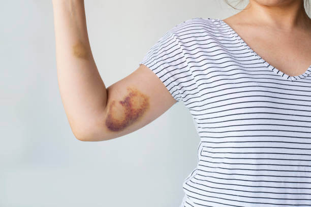 멍 빨리 빼는 법&amp;#44; 멍 드는 과정과 색깔. 멍을 빨리 빼는 방법은 염증을 완화시키고 치유 과정을 가속화하는 다양한 방법들을 포함하고 있습니다. 멍이 생기면 지금 당장 대응하는 것이 중요하며&amp;#44; 올바른 방법을 통해 치료하면 멍의 기간을 단축시킬 수 있습니다.