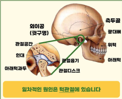 턱 관절 장애 분석 관련 사진