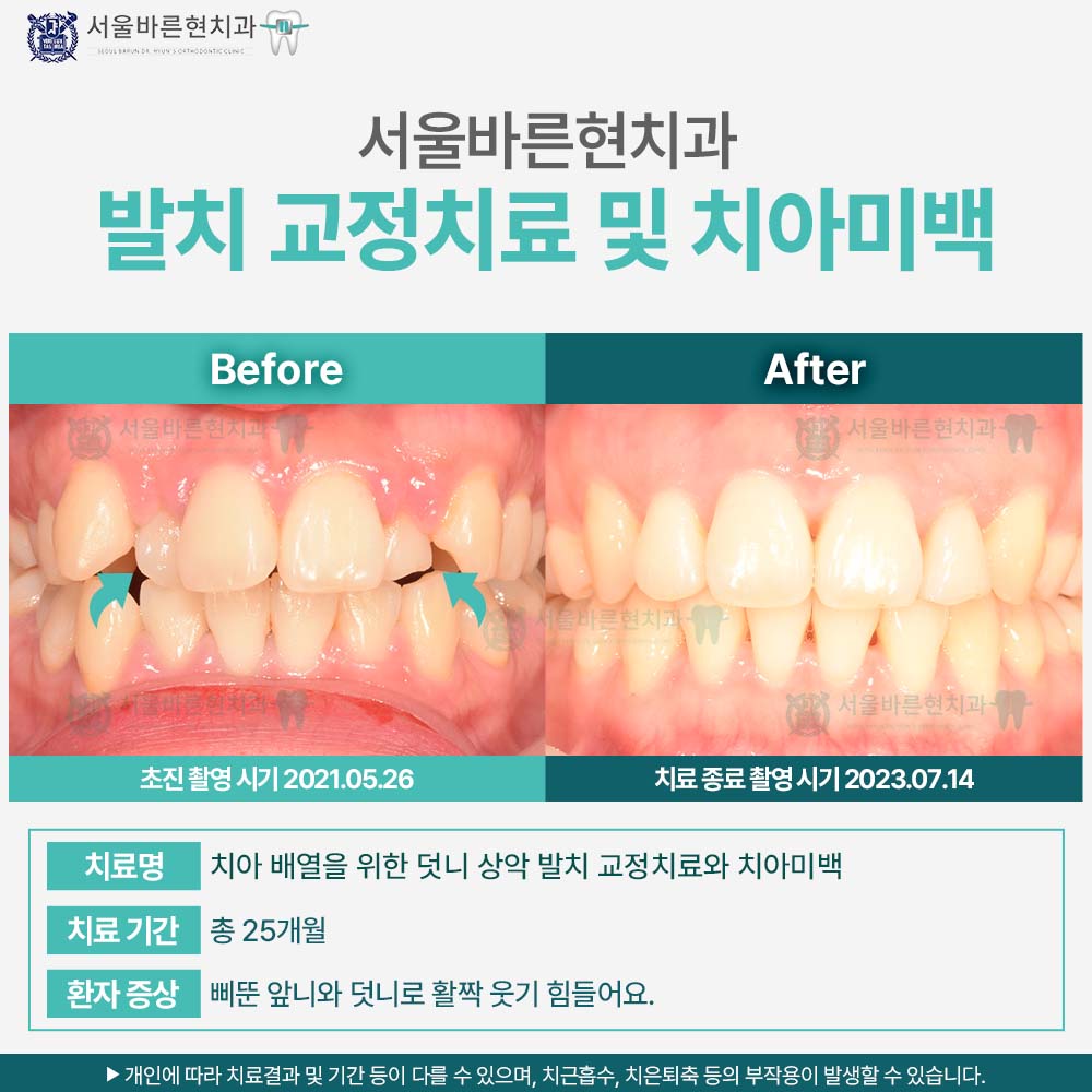 부산치아교정