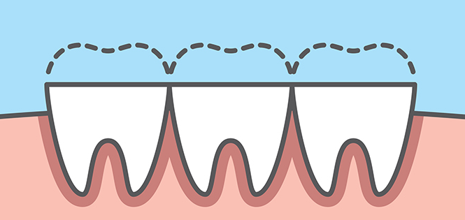 닳아 없어진 치아