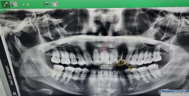암환자의 치아상태