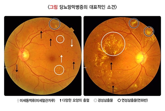당뇨망막병증