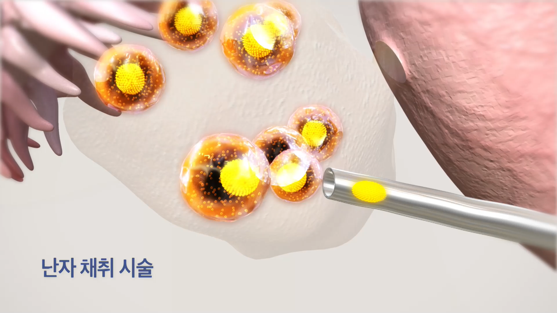 KBS 생로병사의 비밀 836회 난소 노화에 맞서다, 난자 냉동 방법 오늘방송 다시보기 정보