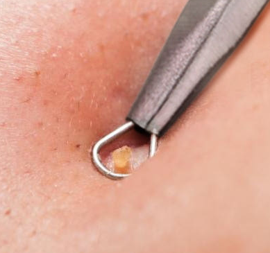 압출기로 여드름을 짜는 모습