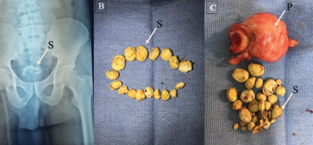방광 결석 진단