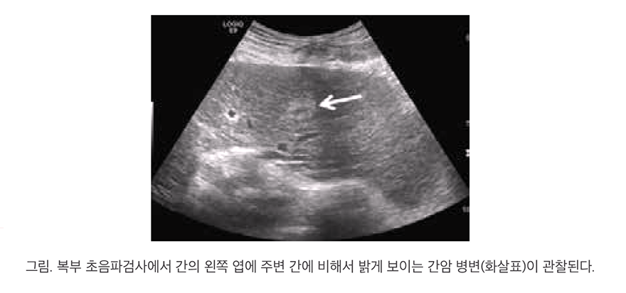 비만으로 간암까지? 술 안 마셔도 위험합니다