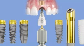 임플란트 종류와 회사 선택, 기간, 수술, 뼈이식