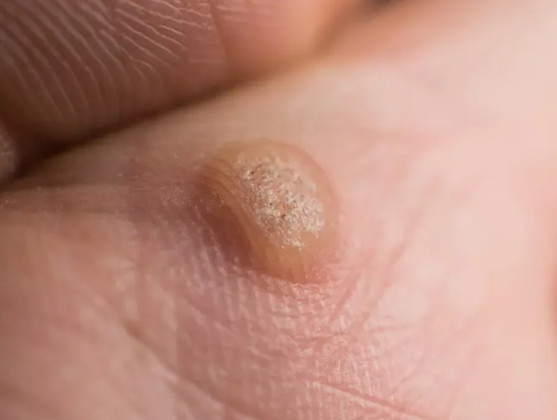 편평사마귀 원인&amp;#44; 증상&amp;#44; 치료 및 주의사항