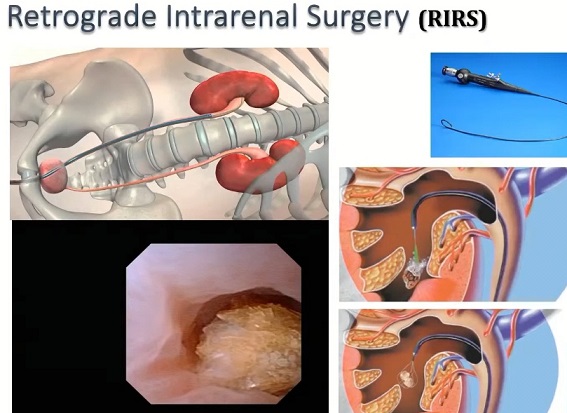 요로결석-명의-구교철-교수-제석술