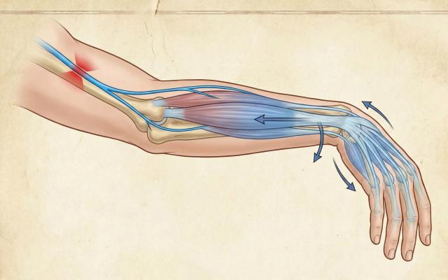 손발 따끔거림 저림 증상 원인 요골신경 마비