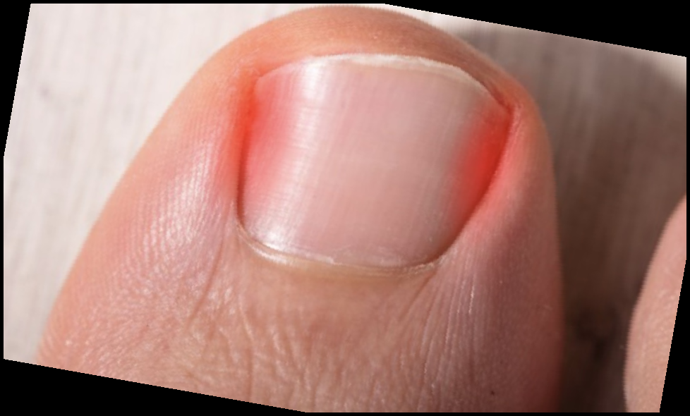 내성발톱 자가치료