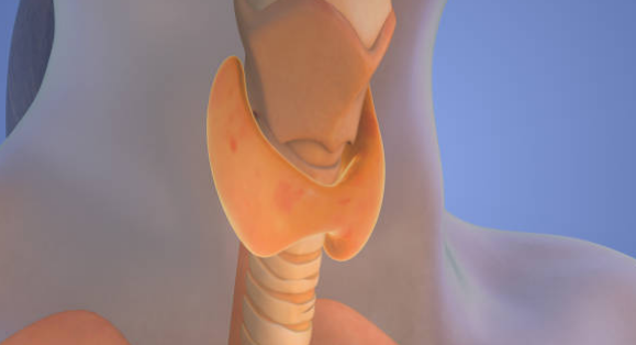 갑상선암 증상, 수술후 회복기간, 수술후 좋은음식 총정리 (2024ver)