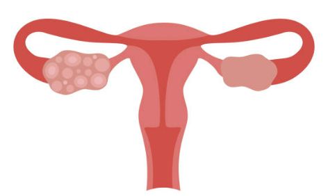 자궁근종 증상 크기별 치료 수술후 회복기간 등 알아보기(최신 Ver)