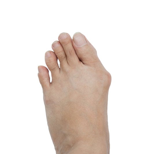 무지외반증 교정 절골술 (Bunionectomy, Osteotomy) &ndash; 수술 방법 &amp; 회복 과정
