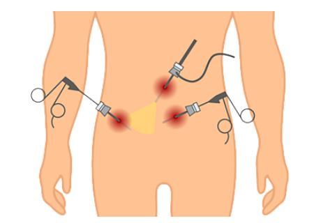 2. 탈장의 정의와 치료 필요성