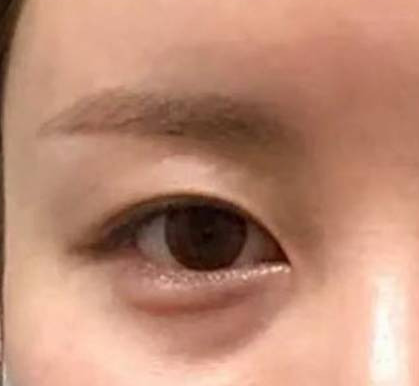 눈 밑 꺼진 사람의 극복 방법