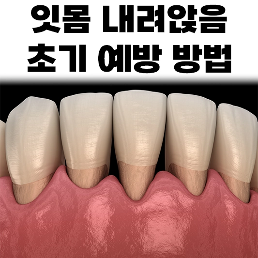 잇몸&#44;내려앉음&#44;섬네일