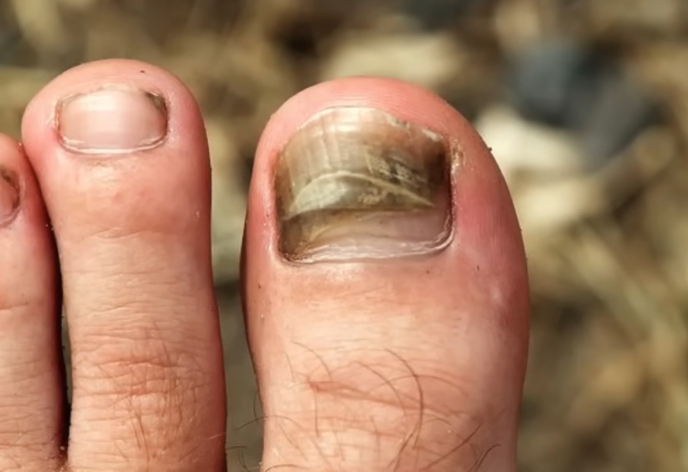 발톱이 검게 변하는 이유