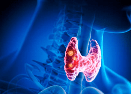 갑상선 기능 저하증 증상