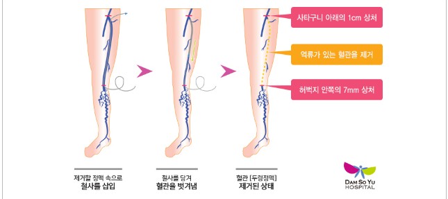 하지정맥류, 방치하면 큰일 난다! 조기 진단의 중요성