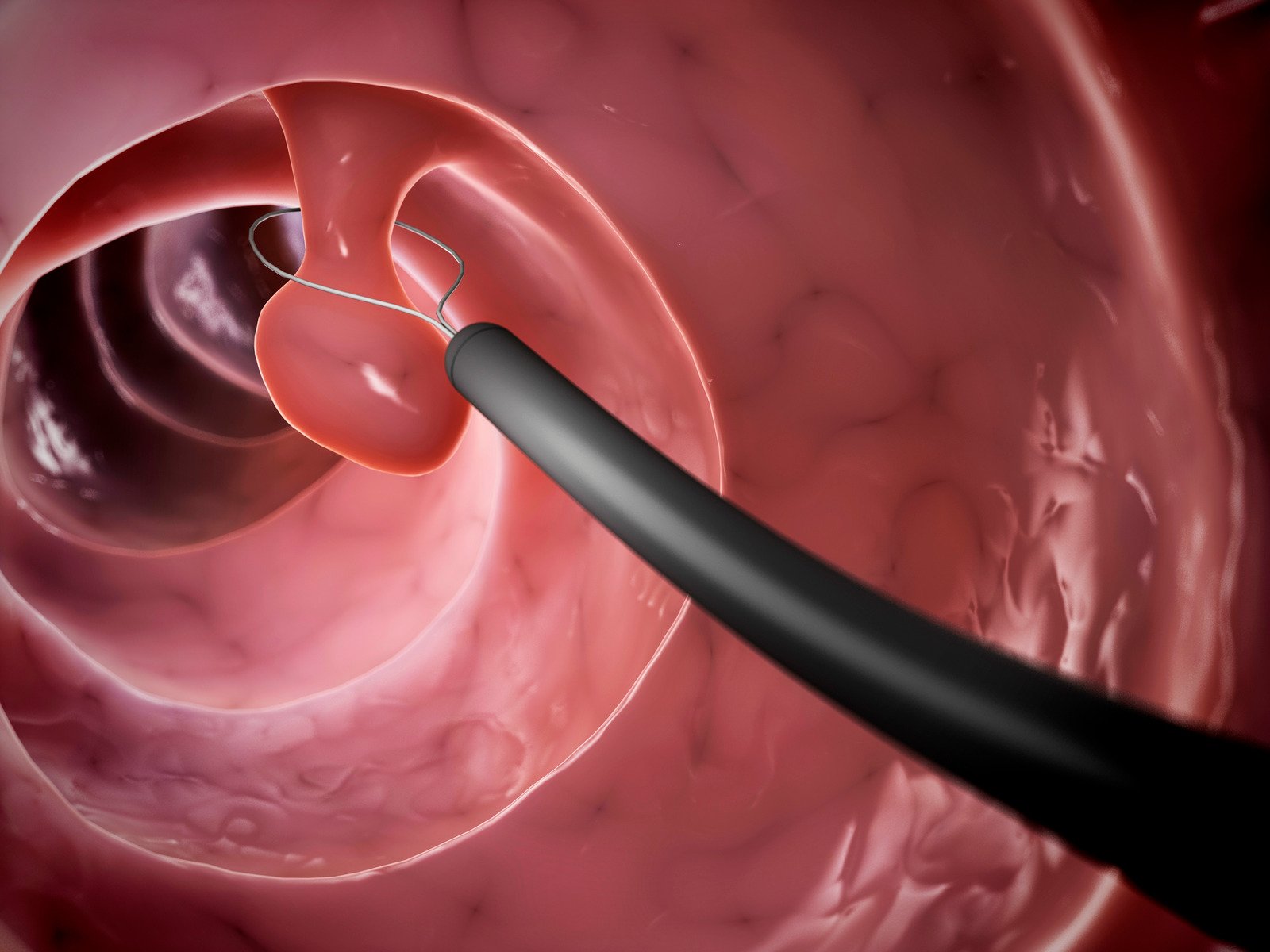 선종성 폴립(Adenomatous Polyp): 전암성 병변