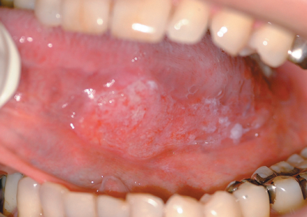 설암(혀암) 초기증상과 원인