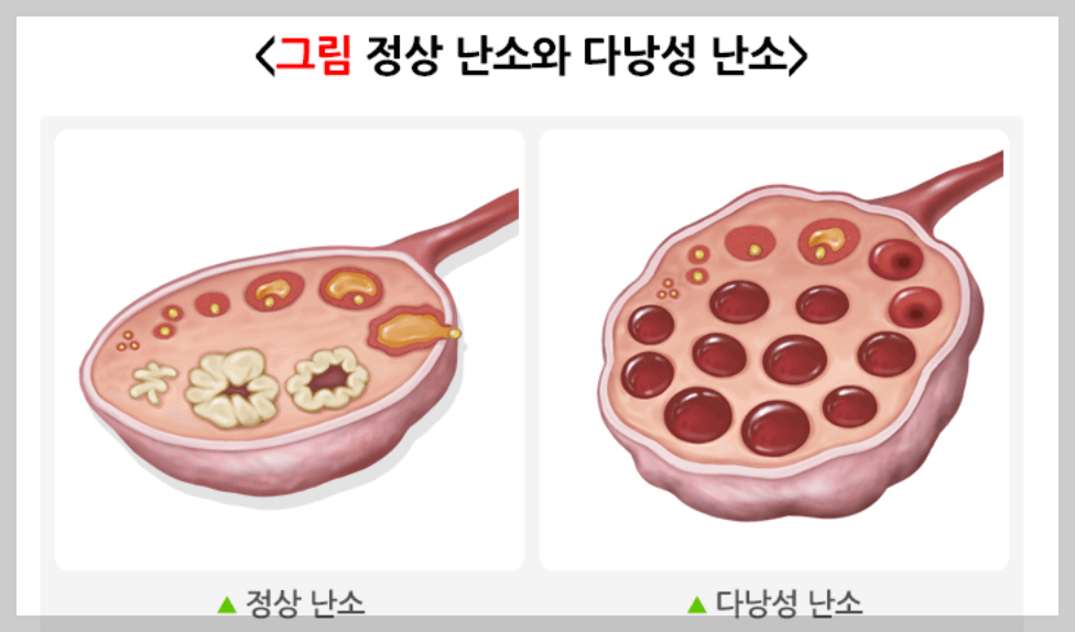다낭성 난소증후군6