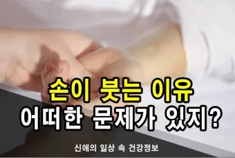 손등 붓는 이유 혈액순환 문제 증상과 해결법 정리_13