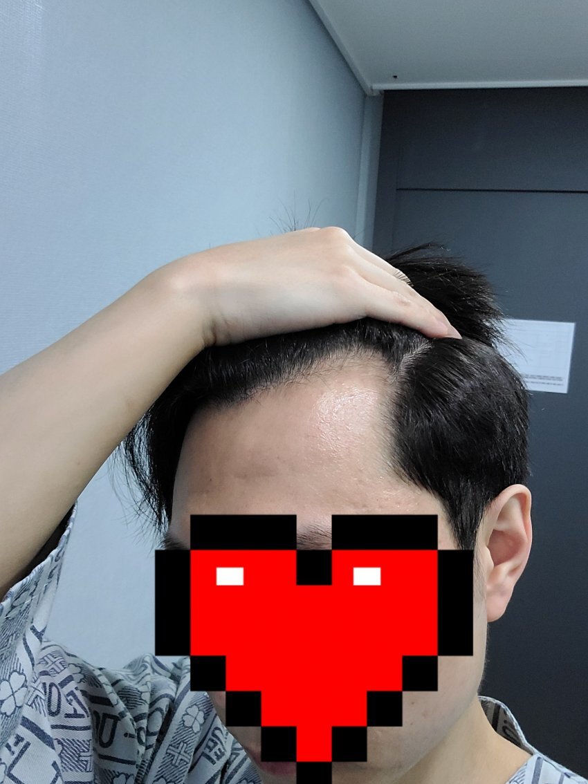 비절개모발이식후기
