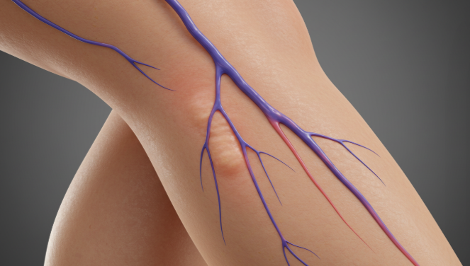 하지정맥류 초기증상 이미지