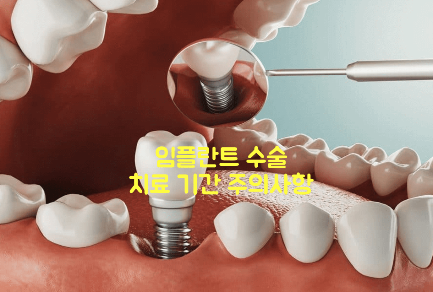 임플란트 치료 기간