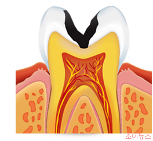 신경 손상 충치