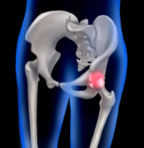 좌골신경통 위치 치료방법