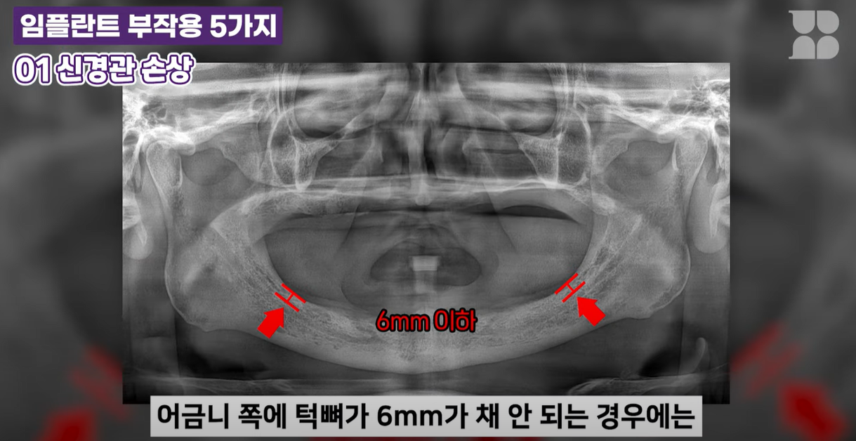 6mm 미만 턱뼈에는 임플란트하면 안됩니다.