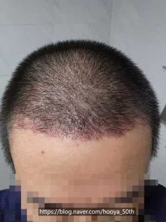 머리카락 이식 3000모 3000모낭 비용과 시술 과정_20