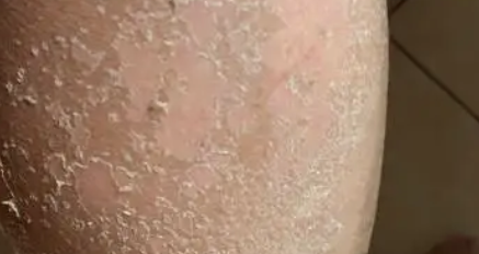 하지 정맥류 증상 26