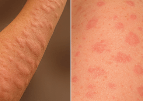 콜린성-두드러기