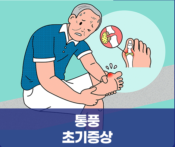 통풍 증가, 폐경 후 여성 환자 주목 관련 이미지