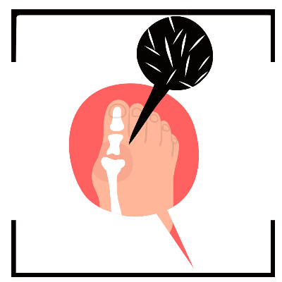 통풍에 좋은 음식