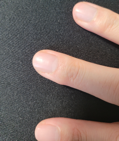 손톱 세로줄 생기는 이유